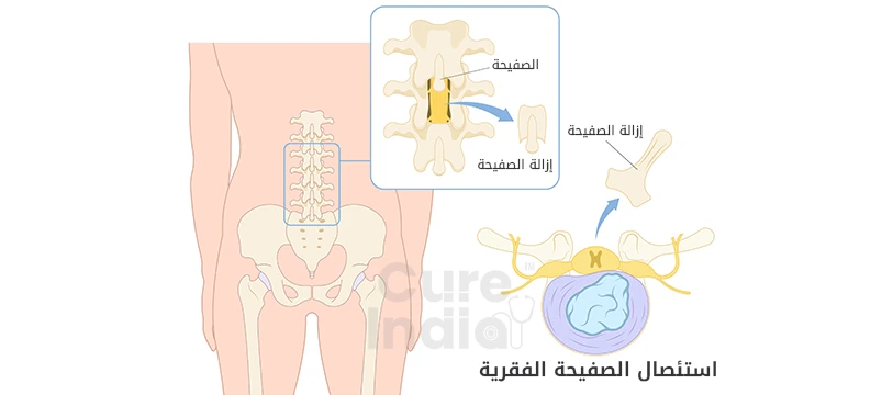 استئصال الصفيحة الفقرية